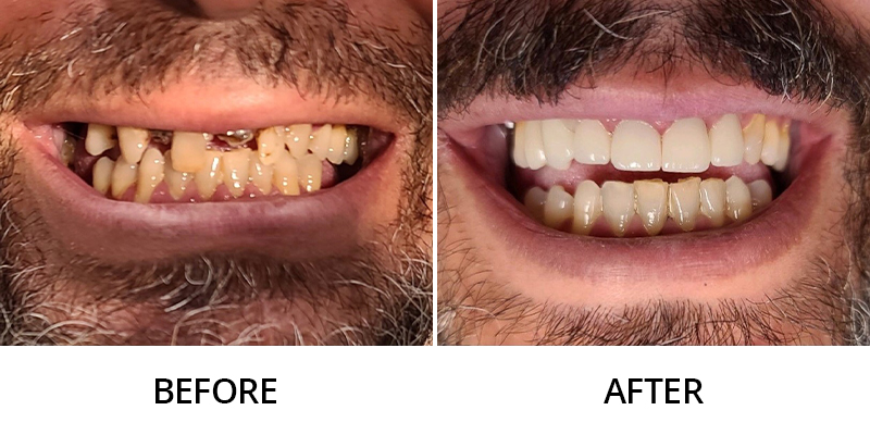 before and after results of missing teethes
