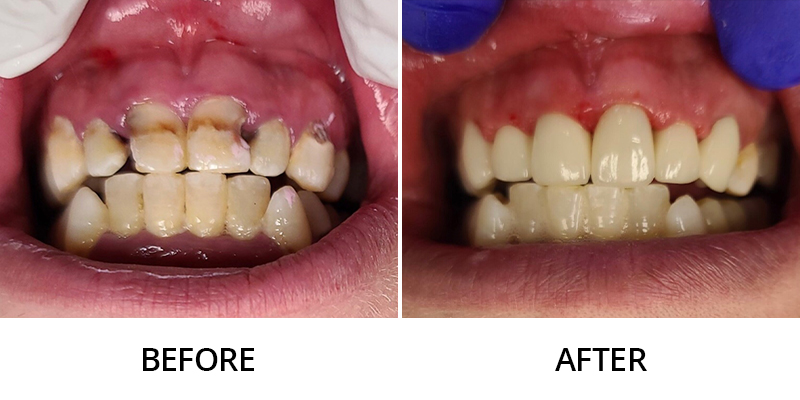 before and after results of teeth straitening