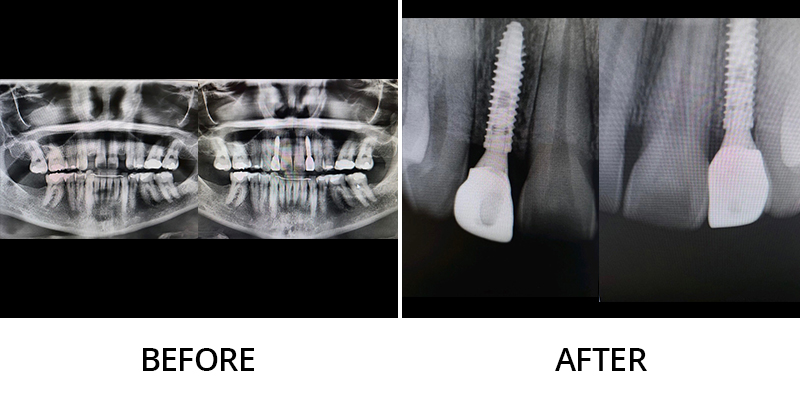 x-ray of before and after results of dental implants procedure