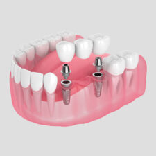 What are the dental bridges, use cases, and work, and how can you get them?